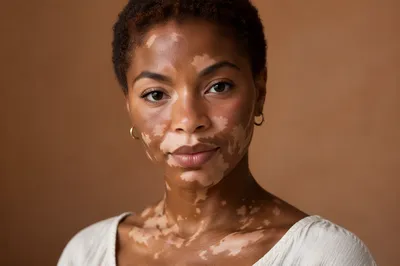 Confident Young Woman with Vitiligo Portrait