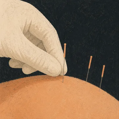 Close-Up Acupuncture Wellness Treatment Scene