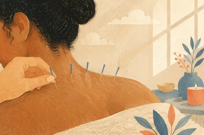 Acupuncture Needles on Shoulder Wellness Close Up