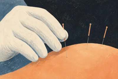 Close-Up Acupuncture Wellness Treatment Scene